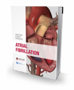 Atrial Fibrillation
