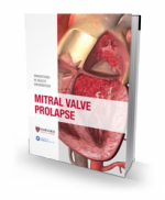 Mitral Valve Prolapse